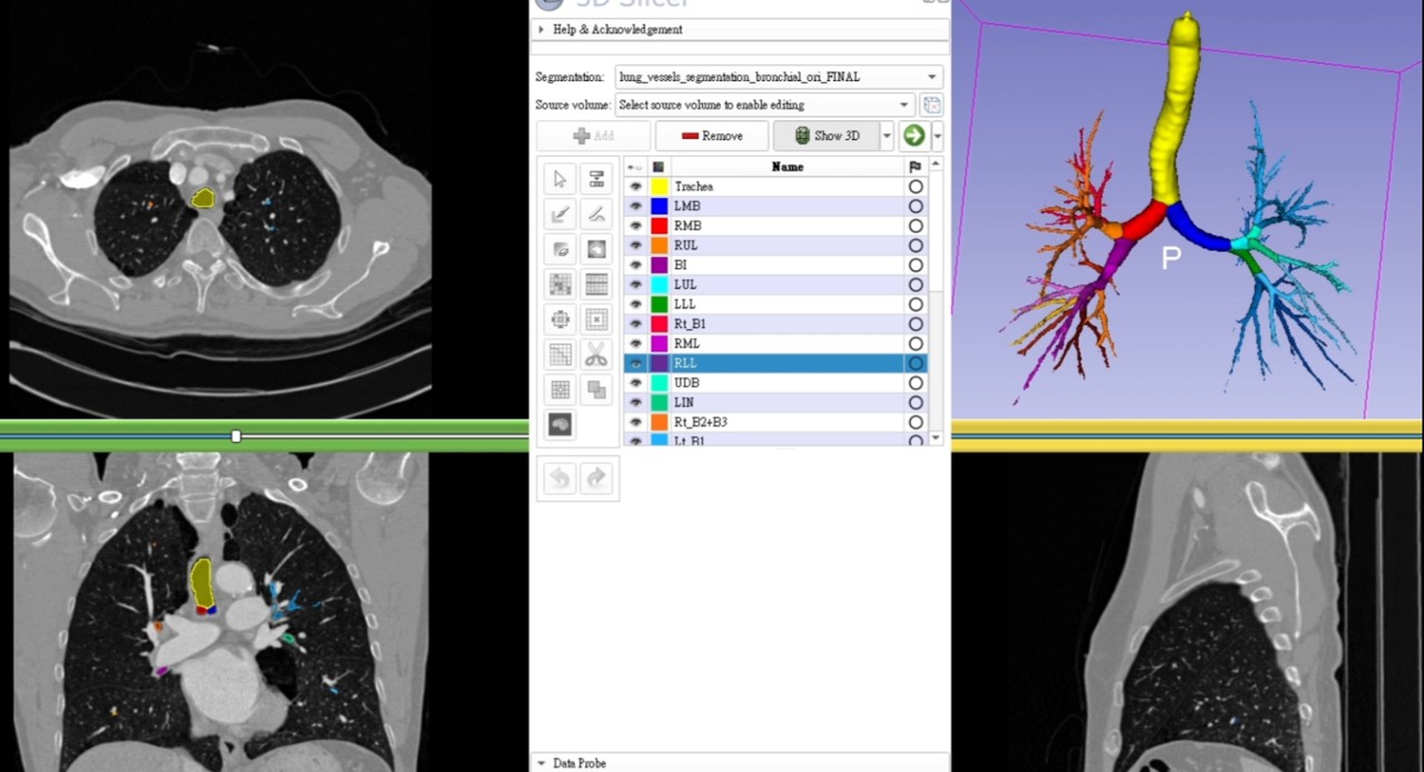Bronchial Branch Parsing 2